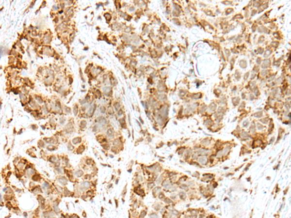 ZKSCAN1 / ZNF36 Antibody - Immunohistochemistry of paraffin-embedded Human thyroid cancer tissue  using ZKSCAN1 Polyclonal Antibody at dilution of 1:30(×200)