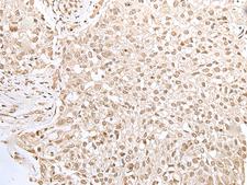 ZKSCAN3 / ZNF306 Antibody - Immunohistochemistry of paraffin-embedded Human lung cancer tissue  using ZKSCAN3 Polyclonal Antibody at dilution of 1:50(×200)