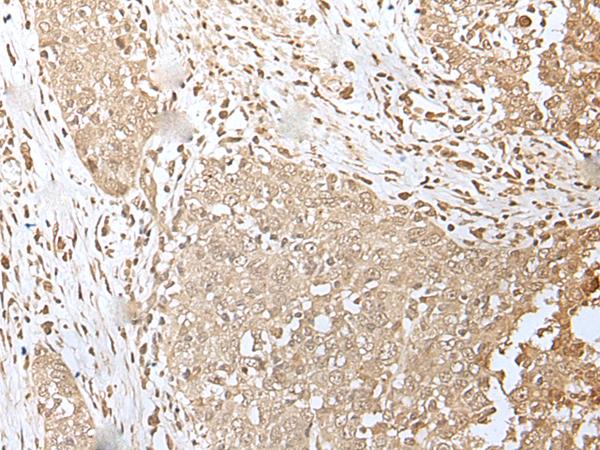 ZKSCAN3 / ZNF306 Antibody - Immunohistochemistry of paraffin-embedded Human esophagus cancer tissue  using ZKSCAN3 Polyclonal Antibody at dilution of 1:50(×200)