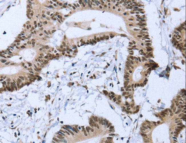ZMAT3 Antibody - Immunohistochemistry of paraffin-embedded Human colon cancer using ZMAT3 Polyclonal Antibody at dilution of 1:30.