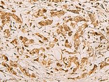 ZMAT4 Antibody - Immunohistochemistry of paraffin-embedded Human gastric cancer tissue  using ZMAT4 Polyclonal Antibody at dilution of 1:65(×200)