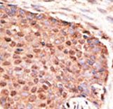 ZMIZ1 Antibody - Formalin-fixed and paraffin-embedded human cancer tissue reacted with the primary antibody, which was peroxidase-conjugated to the secondary antibody, followed by AEC staining. This data demonstrates the use of this antibody for immunohistochemistry; clinical relevance has not been evaluated. BC = breast carcinoma; HC = hepatocarcinoma.