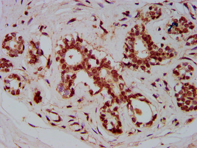 ZMIZ1 Antibody - Immunohistochemistry Dilution at 1:800 and staining in paraffin-embedded human breast cancer performed on a Leica BondTM system. After dewaxing and hydration, antigen retrieval was mediated by high pressure in a citrate buffer (pH 6.0). Section was blocked with 10% normal Goat serum 30min at RT. Then primary antibody (1% BSA) was incubated at 4°C overnight. The primary is detected by a biotinylated Secondary antibody and visualized using an HRP conjugated SP system.