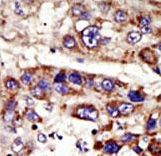 ZMPSTE24 Antibody - Formalin-fixed and paraffin-embedded human cancer tissue reacted with the primary antibody, which was peroxidase-conjugated to the secondary antibody, followed by DAB staining. This data demonstrates the use of this antibody for immunohistochemistry; clinical relevance has not been evaluated. BC = breast carcinoma; HC = hepatocarcinoma.
