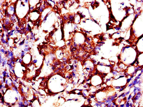 ZMPSTE24 Antibody - Immunohistochemistry of paraffin-embedded human gastric cancer using ZMPSTE24 Antibody at dilution of 1:100