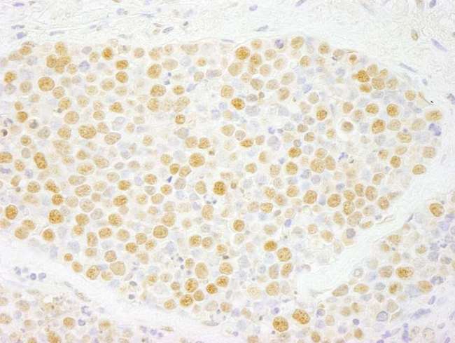 ZMYM2 / RAMP Antibody - Detection of Human ZNF198 by Immunohistochemistry. Sample: FFPE section of human small cell lung cancer. Antibody: Affinity purified rabbit anti-ZNF198 used at a dilution of 1:250.