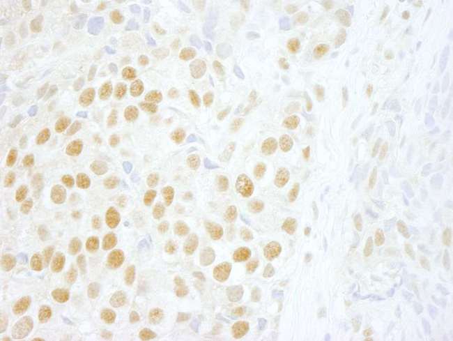 ZMYM2 / RAMP Antibody - Detection of Human ZNF198 by Immunohistochemistry. Sample: FFPE section of human breast carcinoma. Antibody: Affinity purified rabbit anti-ZNF198 used at a dilution of 1:250.