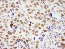 ZMYM3 Antibody - Detection of Human ZNF261 by Immunohistochemistry. Sample: FFPE section of human breast adenocarcinoma. Antibody: Affinity purified rabbit anti-ZNF261 used at a dilution of 1:250.