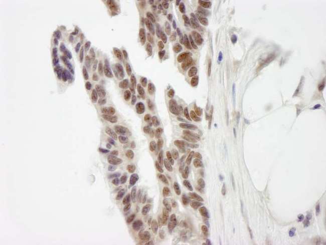 ZMYM3 Antibody - Detection of Human ZNF261 by Immunohistochemistry. Sample: FFPE section of human ovarian carcinoma. Antibody: Affinity purified rabbit anti-ZNF261 used at a dilution of 1:250.