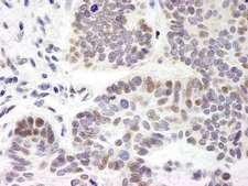 ZMYM3 Antibody - Detection of Human ZNF261 by Immunohistochemistry. Sample: FFPE section of human skin basal cell carcinoma. Antibody: Affinity purified rabbit anti-ZNF261 used at a dilution of 1:5000 (0.2 ug/ml). Detection: DAB.