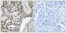 ZMYM4 / ZNF262 Antibody - Immunohistochemistry analysis of paraffin-embedded human breast carcinoma tissue, using ZMYM4 Antibody. The picture on the right is blocked with the synthesized peptide.