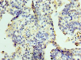 ZMYND10 Antibody - Immunohistochemistry of paraffin-embedded human lung cancer using antibody at 1:100 dilution.