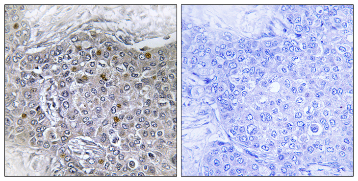 ZMYND11 / BS69 Antibody - Immunohistochemistry analysis of paraffin-embedded human breast carcinoma tissue, using ZMY11 Antibody. The picture on the right is blocked with the synthesized peptide.