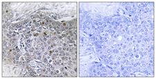 ZMYND11 / BS69 Antibody - Immunohistochemistry analysis of paraffin-embedded human breast carcinoma tissue, using ZMY11 Antibody. The picture on the right is blocked with the synthesized peptide.
