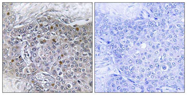 ZMYND11 / BS69 Antibody - Peptide - + Immunohistochemistry analysis of paraffin-embedded human breast carcinoma tissue, using ZMY11 antibody.