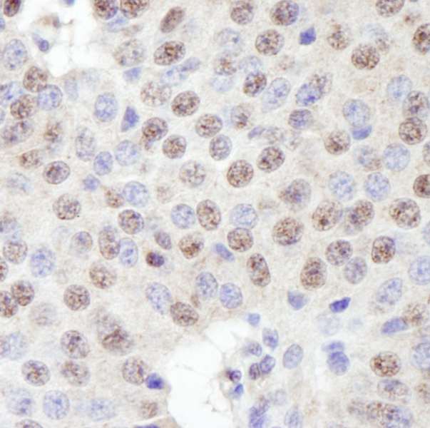 ZNF106 / ZFP106 Antibody - Detection of Human ZFP106 by Immunohistochemistry. Sample: FFPE section of human pancreatic islet cell tumor. Antibody: Affinity purified rabbit anti-ZFP106 used at a dilution of 1:250.