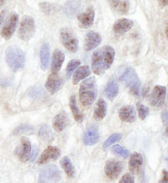 ZNF106 / ZFP106 Antibody - Detection of Human ZFP106 by Immunohistochemistry. Sample: FFPE section of human breast carcinoma. Antibody: Affinity purified rabbit anti-ZFP106 used at a dilution of 1:250.