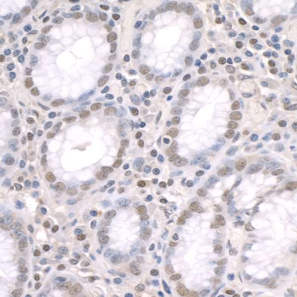 ZNF106 / ZFP106 Antibody - Detection of human ZFP106 by immunohistochemistry. Sample: FFPE section of human stomach cancer. Antibody: Affinity purified rabbit anti-ZFP106 used at a dilution of 1:250. Detection: DAB staining.