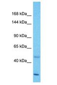 ZNF138 Antibody - ZNF138 antibody Western Blot of Esophagus Tumor. Antibody dilution: 1 ug/ml.  This image was taken for the unconjugated form of this product. Other forms have not been tested.