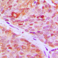 ZNF148 / ZBP-89 Antibody - Immunohistochemical analysis of ZNF148 staining in human breast cancer formalin fixed paraffin embedded tissue section. The section was pre-treated using heat mediated antigen retrieval with sodium citrate buffer (pH 6.0). The section was then incubated with the antibody at room temperature and detected using an HRP-conjugated compact polymer system. DAB was used as the chromogen. The section was then counterstained with hematoxylin and mounted with DPX.