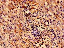 ZNF155 Antibody - Immunohistochemistry of paraffin-embedded human liver cancer using ZNF155 Antibody at dilution of 1:100