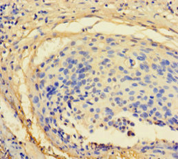 ZNF165 Antibody - Immunohistochemistry of paraffin-embedded human cervical cancer using ZNF165 Antibody at dilution of 1:100