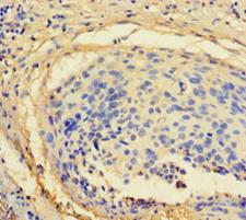 ZNF165 Antibody - Immunohistochemistry of paraffin-embedded human cervical cancer using ZNF165 Antibody at dilution of 1:100