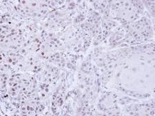 ZNF165 Antibody - IHC of paraffin-embedded Cal27 Xenograft using ZNF165 antibody at 1:100 dilution.