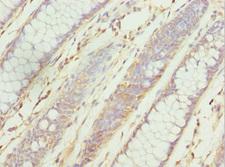ZNF169 Antibody - Immunohistochemistry of paraffin-embedded human colon cancer at dilution 1:100