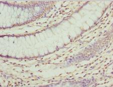 ZNF169 Antibody - Immunohistochemistry of paraffin-embedded human colon cancer at dilution 1:100