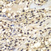 ZNF169 Antibody - Immunohistochemistry of paraffin-embedded Human kidney cancer using ZNF169 Polyclonal Antibody at dilution of 1:100 (40x lens).