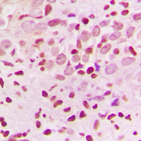 ZNF174 Antibody - Immunohistochemical analysis of ZNF174 staining in human breast cancer formalin fixed paraffin embedded tissue section. The section was pre-treated using heat mediated antigen retrieval with sodium citrate buffer (pH 6.0). The section was then incubated with the antibody at room temperature and detected using an HRP conjugated compact polymer system. DAB was used as the chromogen. The section was then counterstained with hematoxylin and mounted with DPX.