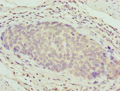 ZNF177 / PIGX Antibody - Immunohistochemistry of paraffin-embedded human gastric cancer using ZNF177 Antibody at dilution of 1:100