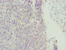 ZNF187 Antibody - Immunohistochemistry of paraffin-embedded human cervical cancer at dilution 1:100