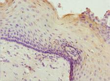ZNF187 Antibody - Immunohistochemistry of paraffin-embedded human cervical cancer at dilution 1:100