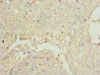 ZNF187 Antibody - Immunohistochemistry of paraffin-embedded human lung cancer at dilution 1:100