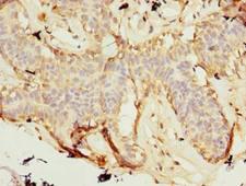ZNF19 Antibody - Immunohistochemistry of paraffin-embedded human breast cancer using antibody at dilution of 1:100.