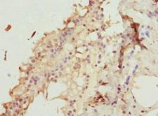 ZNF191 / ZNF24 Antibody - Immunohistochemistry of paraffin-embedded human breast cancer at dilution 1:100