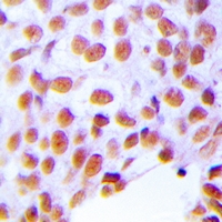 ZNF191 / ZNF24 Antibody - Immunohistochemical analysis of ZNF24 staining in human breast cancer formalin fixed paraffin embedded tissue section. The section was pre-treated using heat mediated antigen retrieval with sodium citrate buffer (pH 6.0). The section was then incubated with the antibody at room temperature and detected with HRP and DAB as chromogen. The section was then counterstained with hematoxylin and mounted with DPX.