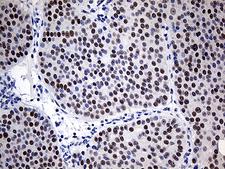 ZNF2 Antibody - Immunohistochemical staining of paraffin-embedded Carcinoma of Human pancreas tissue using anti-ZNF2 mouse monoclonal antibody. (Heat-induced epitope retrieval by 1mM EDTA in 10mM Tris buffer. (pH8.5) at 120°C for 3 min. (1:500)