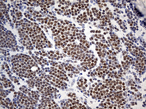 ZNF2 Antibody - Immunohistochemical staining of paraffin-embedded Human lymphoma tissue using anti-ZNF2 mouse monoclonal antibody. (Heat-induced epitope retrieval by 1mM EDTA in 10mM Tris buffer. (pH8.5) at 120°C for 3 min. (1:500)