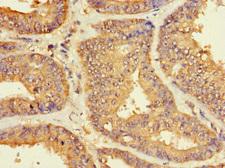 ZNF2 Antibody - Immunohistochemistry of paraffin-embedded human endometrial cancer at dilution 1:100