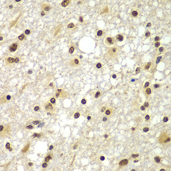 ZNF20 Antibody - Immunohistochemistry of paraffin-embedded human brain cancer tissue.