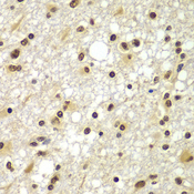 ZNF20 Antibody - Immunohistochemistry of paraffin-embedded human brain cancer tissue.
