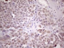 ZNF200 Antibody - Immunohistochemical staining of paraffin-embedded Adenocarcinoma of Human ovary tissue using anti-ZNF200 mouse monoclonal antibody. (Heat-induced epitope retrieval by 1 mM EDTA in 10mM Tris, pH8.5, 120C for 3min. (1:150)