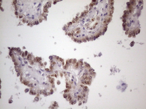 ZNF200 Antibody - Immunohistochemical staining of paraffin-embedded Carcinoma of Human thyroid tissue using anti-ZNF200 mouse monoclonal antibody. (Heat-induced epitope retrieval by 1 mM EDTA in 10mM Tris, pH8.5, 120C for 3min. (1:150)