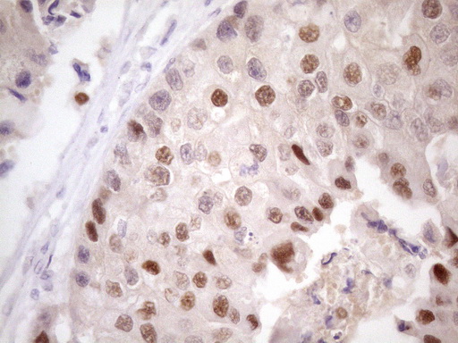 ZNF200 Antibody - Immunohistochemical staining of paraffin-embedded Adenocarcinoma of Human breast tissue using anti-ZNF200 mouse monoclonal antibody. (Heat-induced epitope retrieval by 1 mM EDTA in 10mM Tris, pH8.5, 120C for 3min. (1:150)