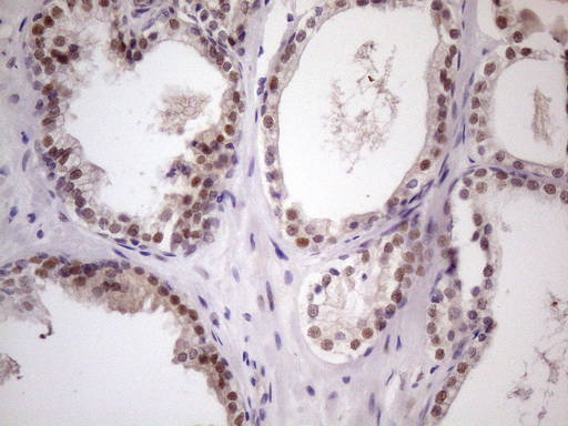 ZNF200 Antibody - Immunohistochemical staining of paraffin-embedded Carcinoma of Human prostate tissue using anti-ZNF200 mouse monoclonal antibody. (Heat-induced epitope retrieval by 1 mM EDTA in 10mM Tris, pH8.5, 120C for 3min. (1:150)