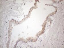 ZNF200 Antibody - Immunohistochemical staining of paraffin-embedded Carcinoma of Human prostate tissue using anti-ZNF200 mouse monoclonal antibody. (Heat-induced epitope retrieval by 1mM EDTA in 10mM Tris buffer. (pH8.5) at 120°C for 3 min. (1:150)
