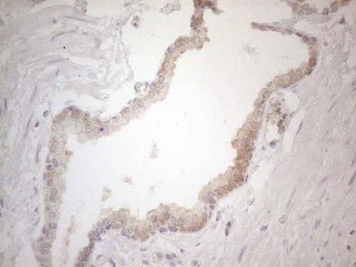 ZNF200 Antibody - Immunohistochemical staining of paraffin-embedded Carcinoma of Human prostate tissue using anti-ZNF200 mouse monoclonal antibody. (Heat-induced epitope retrieval by 1mM EDTA in 10mM Tris buffer. (pH8.5) at 120°C for 3 min. (1:150)